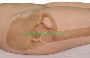 Schnittführung bei anterolateralem Zugang